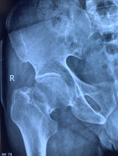 天天健康老年人髋部骨折怎么治疗