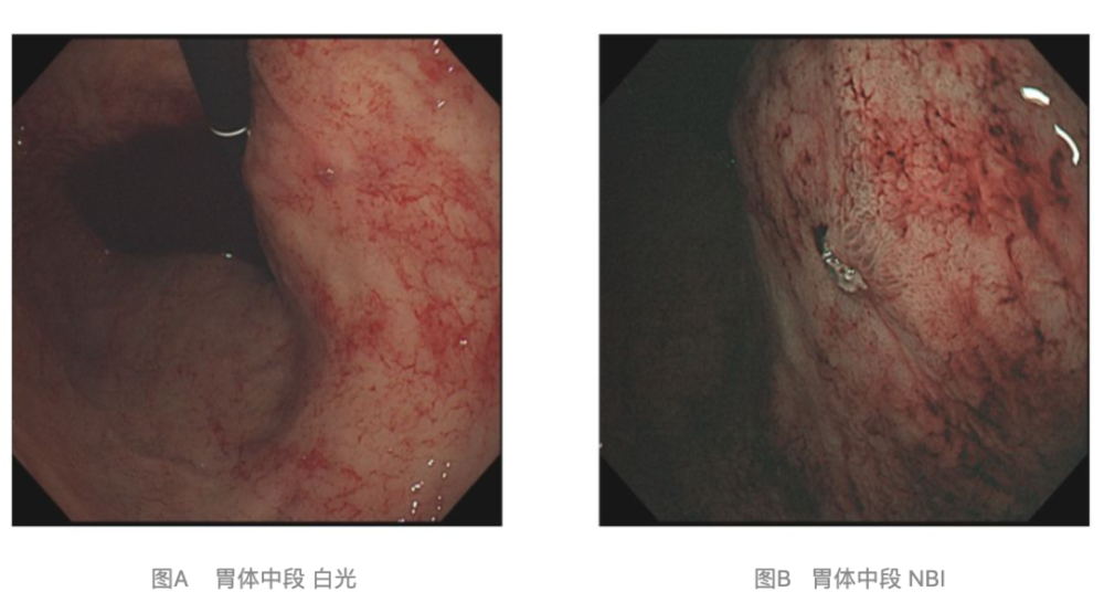 完善急诊胃镜提示:胃体中段小弯侧黏膜有一裸露血管向胃内喷射性出血