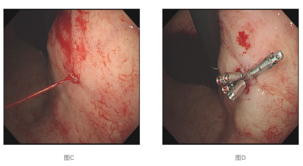50 %,占上消化道大出血手术的1.3%-2.3%[1].
