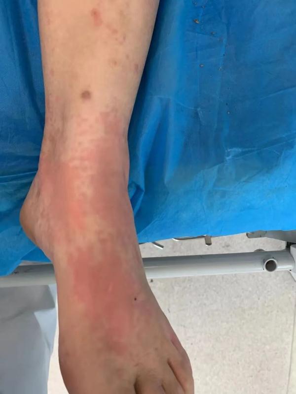 杭州俩阿姨被蜂蜇伤送急诊医生提醒千万不能这么做