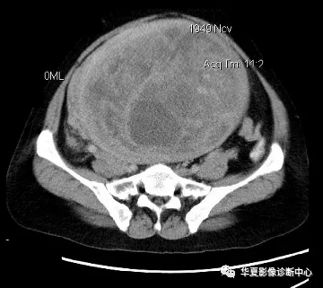 【經典】盆腔巨大腫塊ct診斷與鑑別