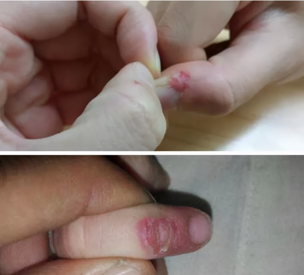 孩子抠手指是缺维生素别大意孩子抠手指背后的心理因素要知道