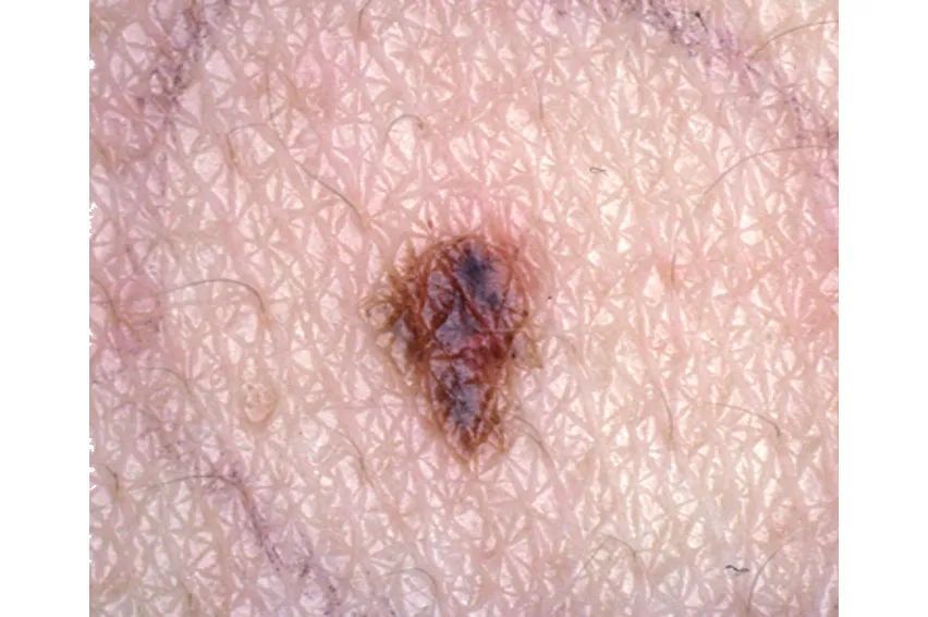 激光会使痣恶变吗?