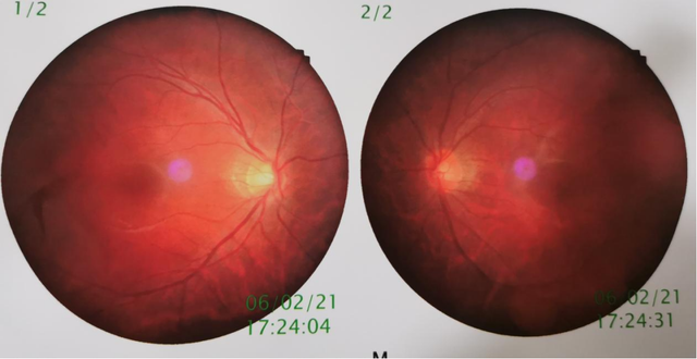 明明是中度近视却有着高度近视的眼底这是为啥