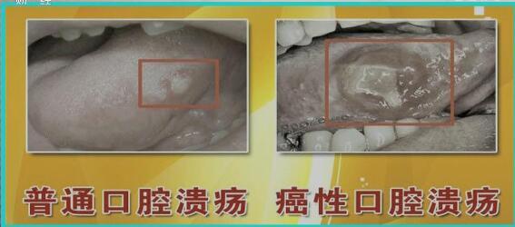 如何区别口腔溃疡是良性还是恶性?