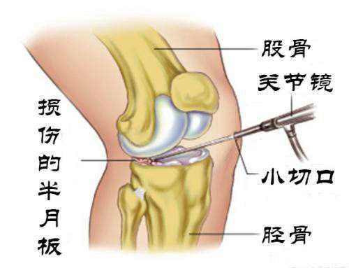 膝半月板位置图片图片