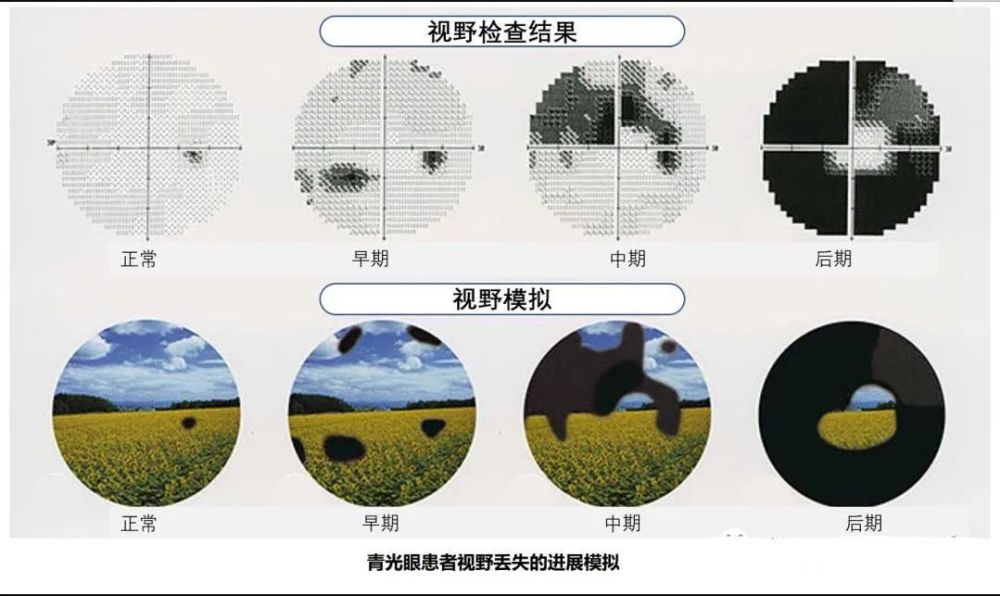 白内障青光眼雅安仁康医院眼科一次手术同时解决