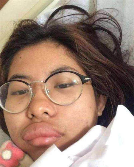 "香肠嘴"女子走红网络,变肿原因却让人哭笑不得