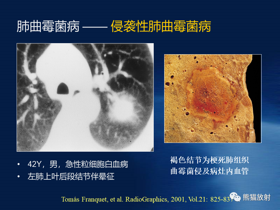 肺真菌病丨影像學表現與病理對照_騰訊新聞