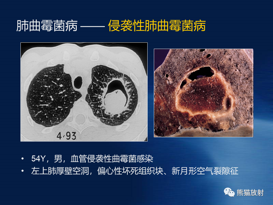 肺真菌病丨影像學表現與病理對照_騰訊新聞