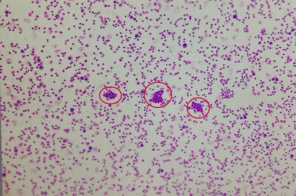 于是重新制片,第二次镜检如下:散在或成堆排列的异常细胞明显增多,该