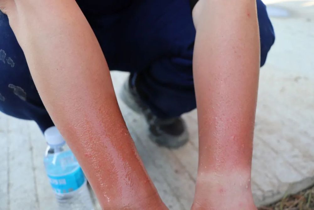 黑河抗洪消防员双臂被晒伤 已连续九天坚守抗洪抢险一线_腾讯新闻