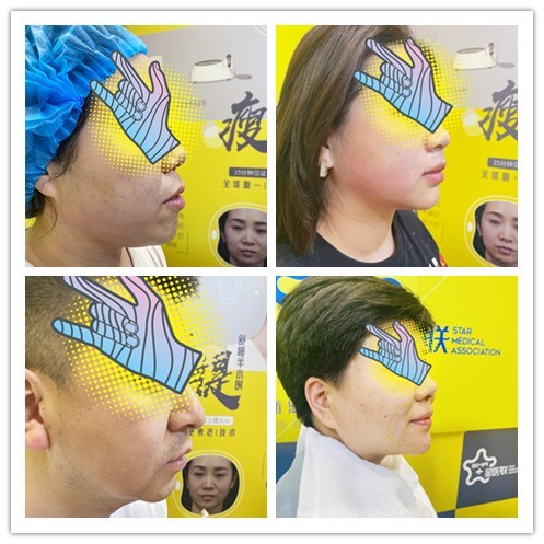 又现黑科技雕刻家下颌线制造机这波可以跟着博主冲