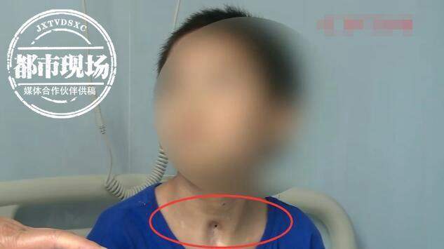 10岁男童因气管狭窄颈部"戴管",等待3年终于顺利拔除