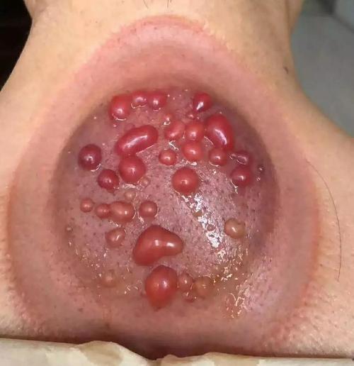 拔火罐时后背出现的瘀血是排出的毒素吗真相来了