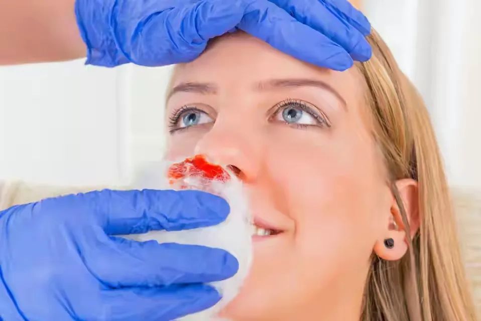 如果遇上只能用冷敷止血的特殊情况,建议冷敷鼻根,鼻梁部位,距离鼻