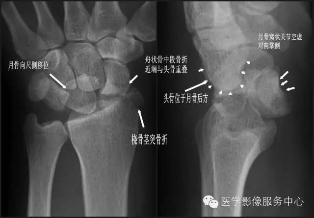 月骨可向尺側移位,月骨窩狀關節空虛,對向掌側;舟狀骨中段骨折,近端與