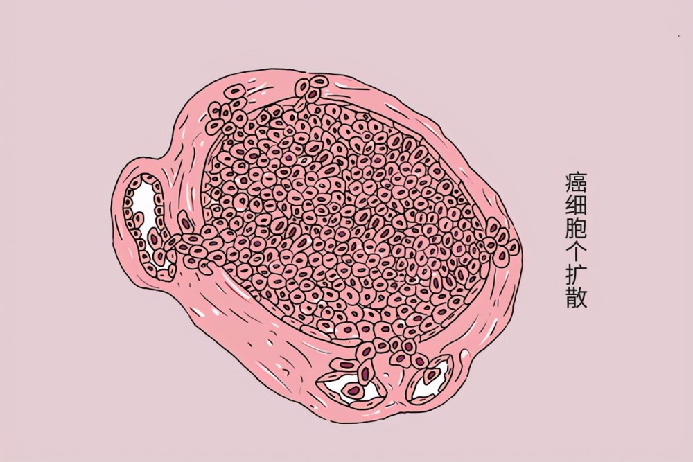 部分癌症患者癌细胞扩散后食欲和精神依旧很好说明了什么
