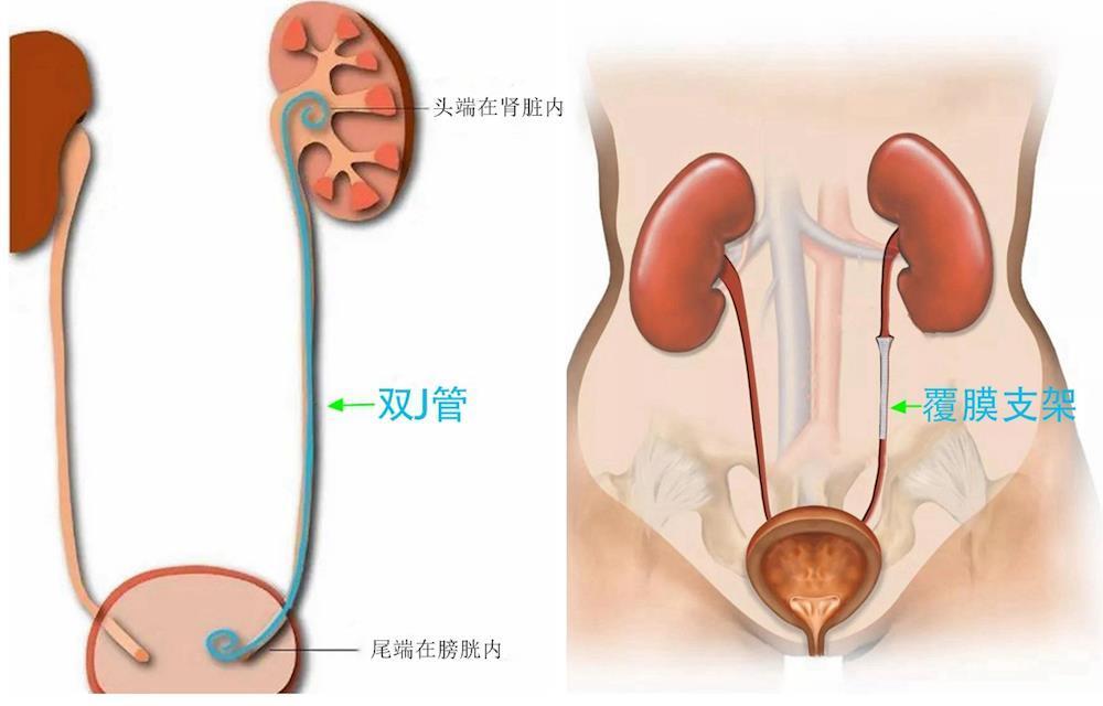 肾积水插管手术图解图片