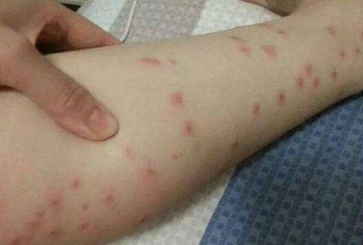 医生:丘疹性荨麻疹是一种迟发性的过敏反应,从高峰期到症状缓解,需要