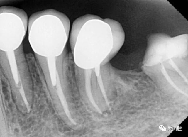 上頜第三磨牙4根管根充1例上頜第一磨牙牙外吸收rct 冠修復1例上頜5-5