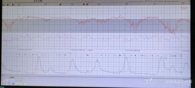 孕40 周胎动减少 出现混合型胎监 如何处理 胎动 胎监 彩超 孕期