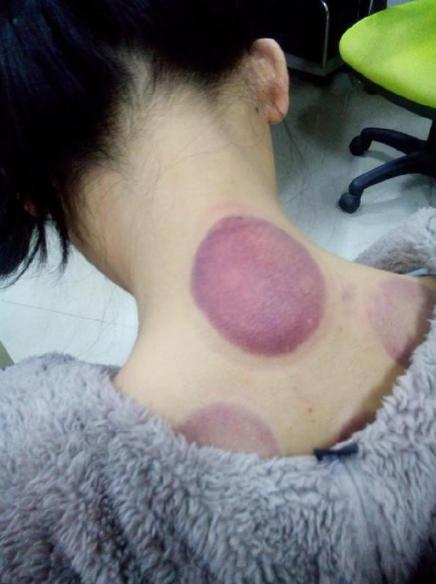 4,孕妇腹部和腰骶部者;5,女性月经期间;6,过于瘦弱的人也应慎用拔罐法