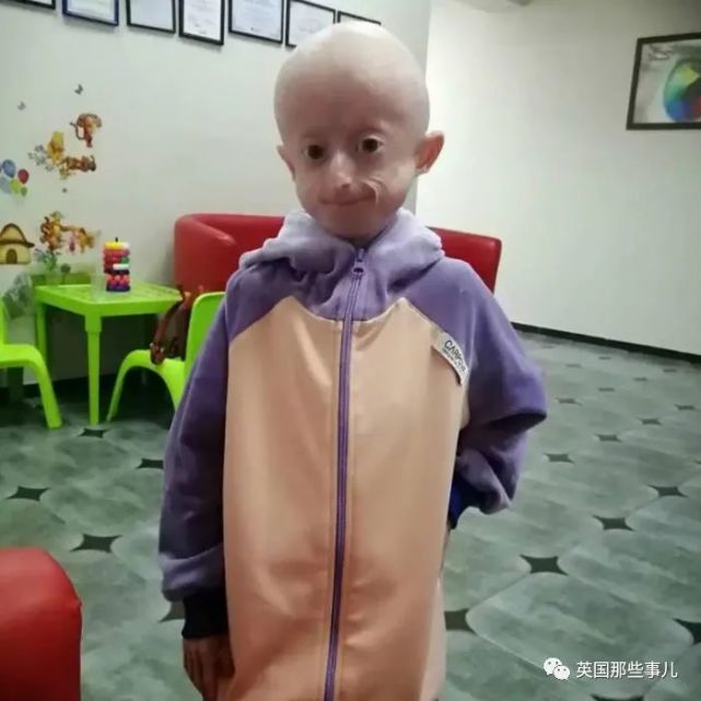 中国早衰症儿童图片