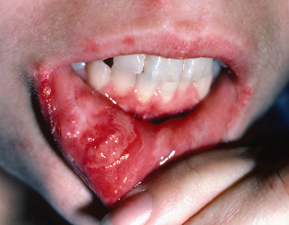 反复口腔溃疡,是怎么回事?_腾讯新闻