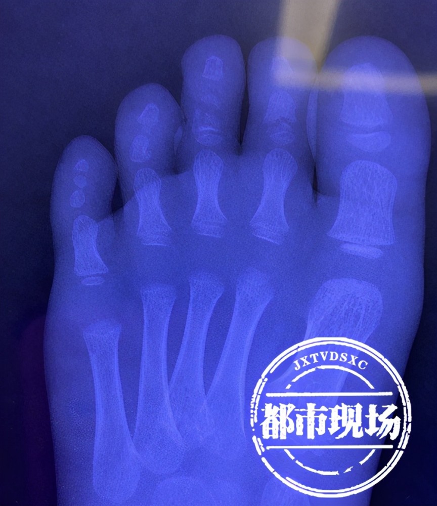 南昌3岁男童"搬石头砸了自己脚",2根脚趾砸断_腾讯新闻