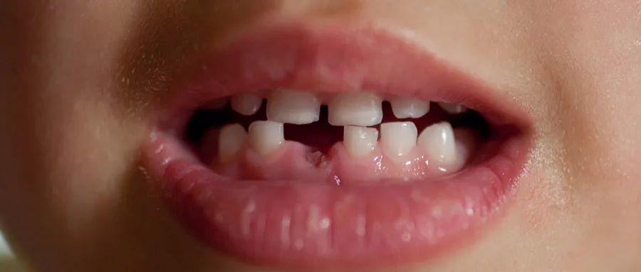 6岁男孩一口牙齿几乎全毁最伤孩子牙齿的不是糖而是