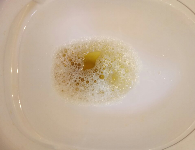 4,尿液颜色出现变化健康的人排尿的时候,尿液颜色一般都是特别清澈,有