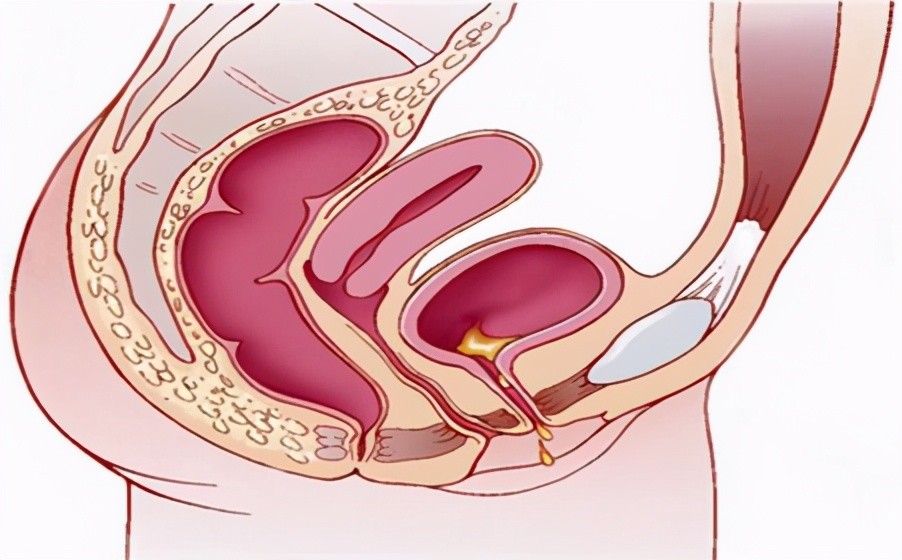 但是,到了盛夏,女性尿道和膀胱容易充血,肿胀,当出汗多,饮水少时,尿液