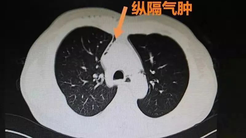 急诊科的医生看过来:最全胸痛急诊的常见病因,看这一篇就够了