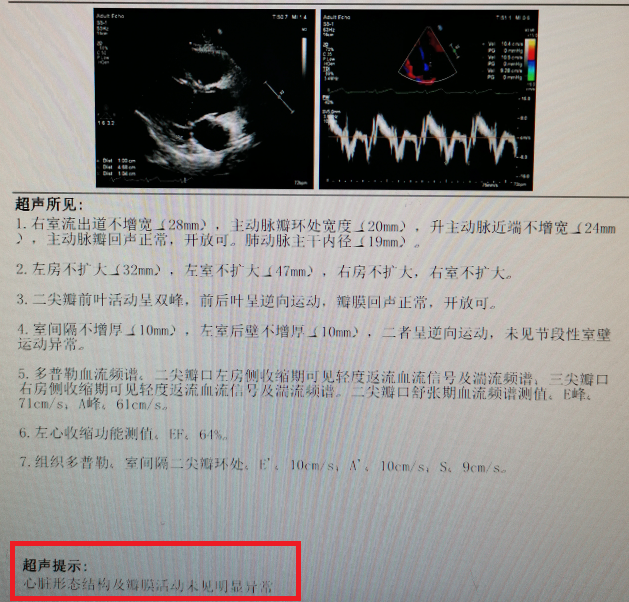 经食管超声(tee)显示卵圆孔未闭图7 右心声学造影显示valsalva状态下