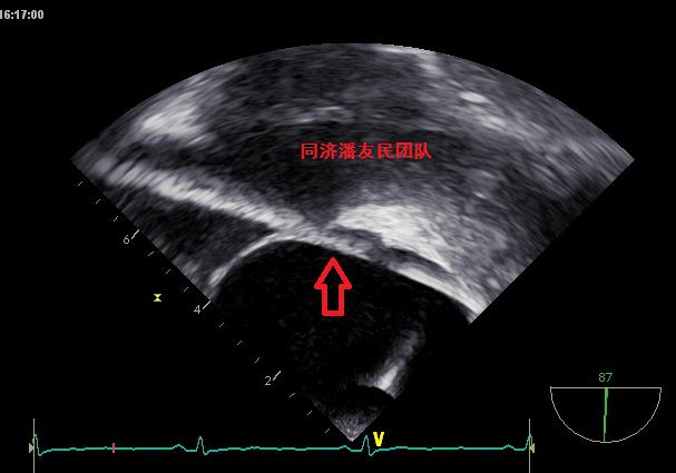 封堵器輸送鞘穿過卵圓孔進入左房(紅箭頭所示)