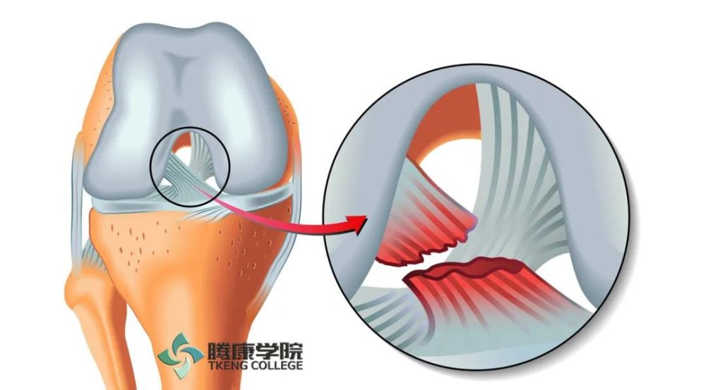 前交叉韧带撕裂分析与评估治疗 腾讯新闻