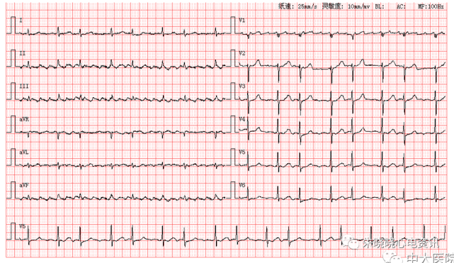 每日读图|第1429期 房扑 肢体导联qrs低电压|导联|心电图|心房扑动