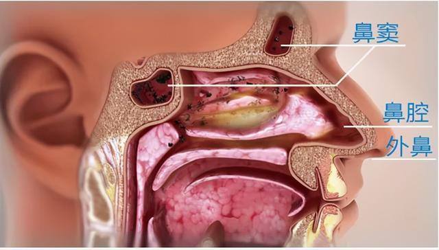 鼻炎or鼻窦炎一鼻之差症状大不同