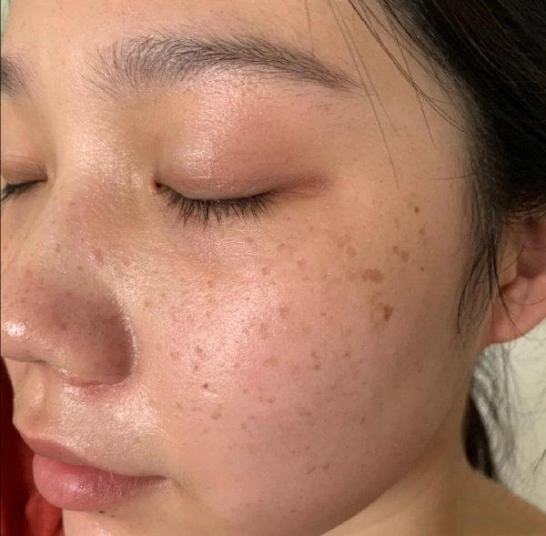 脸上为什么长斑?