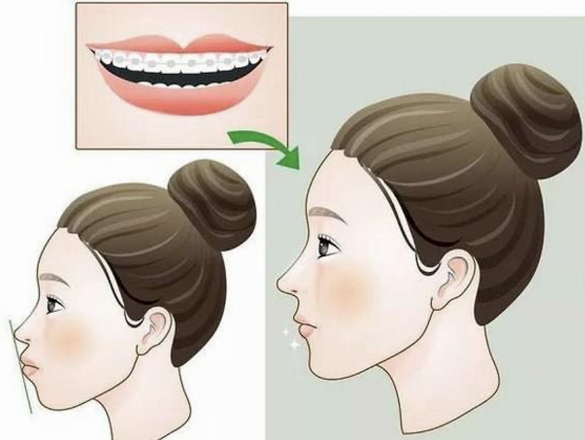 深圳牙齒矯正-牙齒矯正前戴了擴弓器會讓臉變大嗎?