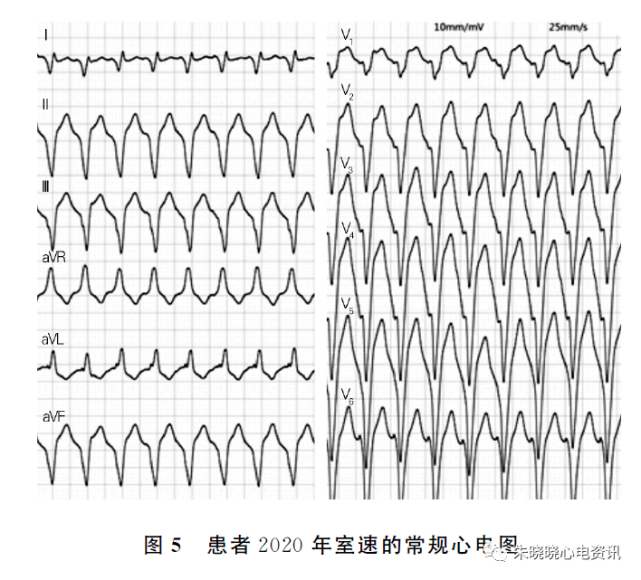 随访18年心电图epsilon波变化