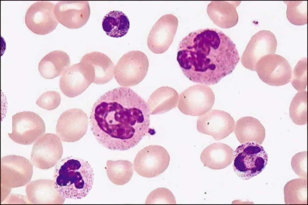 陈根:中性粒细胞,免疫治疗毒副作用的背后推手?