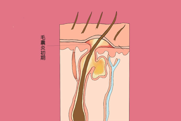 头皮上为什么总是有小疙瘩 是痘痘吗 提醒大家 不要用手抠 腾讯新闻