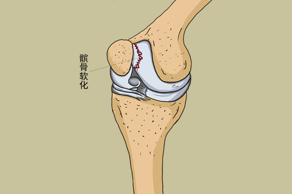 人到中年 一打篮球就觉得膝盖疼 怎么回事 如何保护膝关节