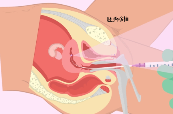 胚胎移植后在子宫图片图片