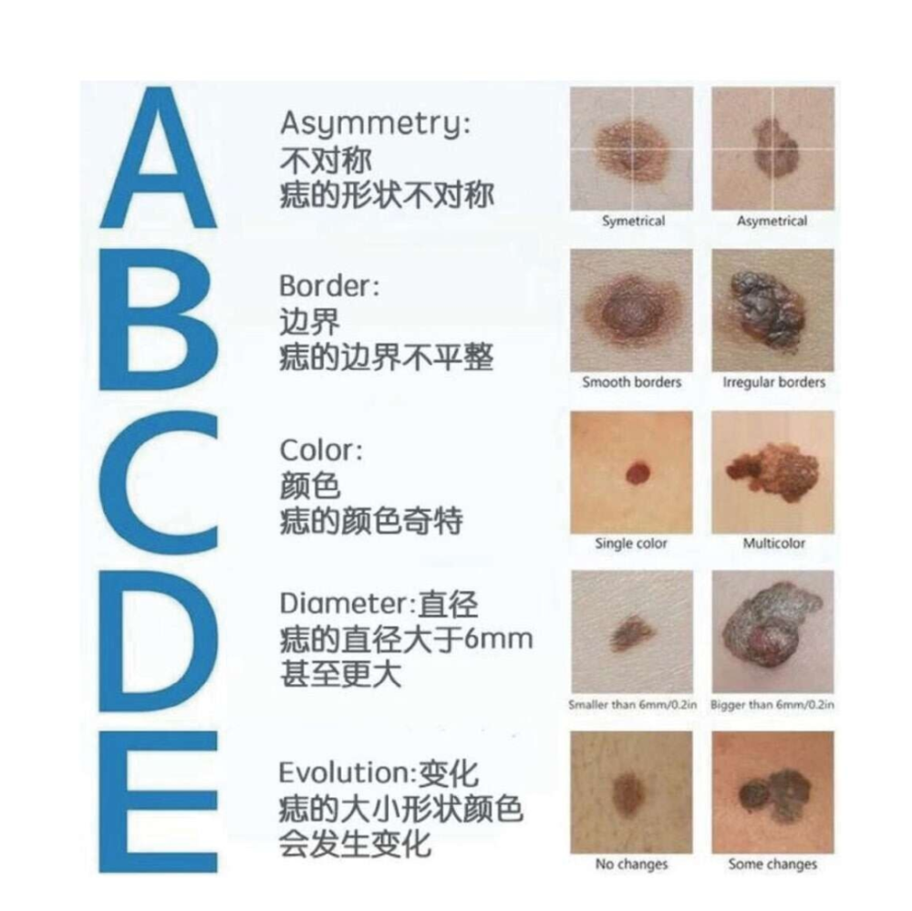 身上的痣出现5种症状需警惕是恶性黑色素瘤
