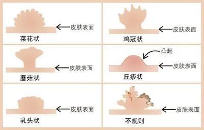 表现症状:尖锐湿疣可以为细小淡红色丘疹,增大后呈乳头样,鸡冠状或