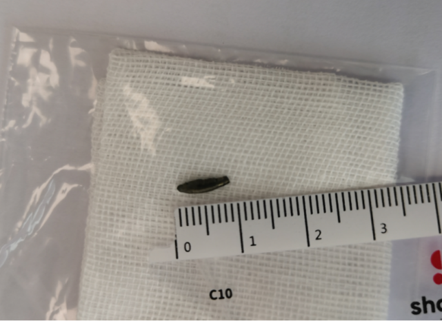 1cm金属插进右眼球东莞男子接受手术后成功挽救视力