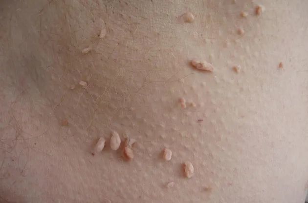 你已经感染了hpv病毒!我们俗称的"瘊子",医学上一般称之为"疣".